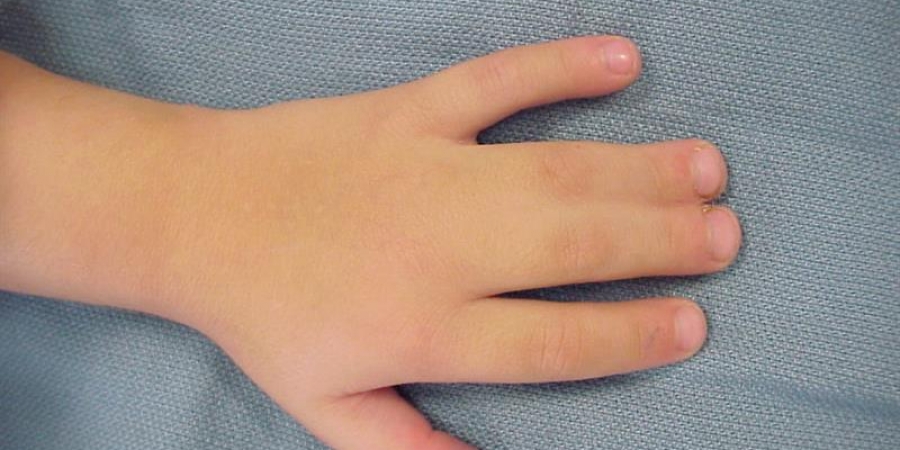 Webbed Fingers – Syndactyly